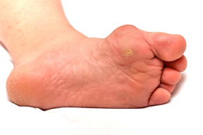 What’s the Difference Between Bunions and Corns?