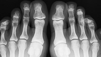 What Can Happen to an Untreated Broken Toe?