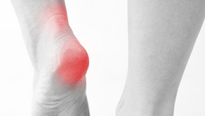 Can Extracorporeal Shock Wave Therapy (ESWT) help with Plantar Fasciitis?