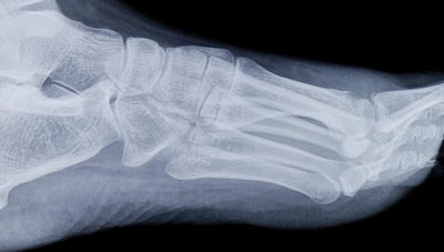 What Are Your Options If a Bone Injury in Your Foot Isn’t Healing