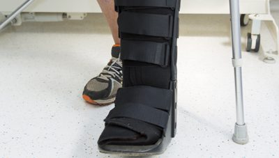 What to Expect After Bunion Surgery