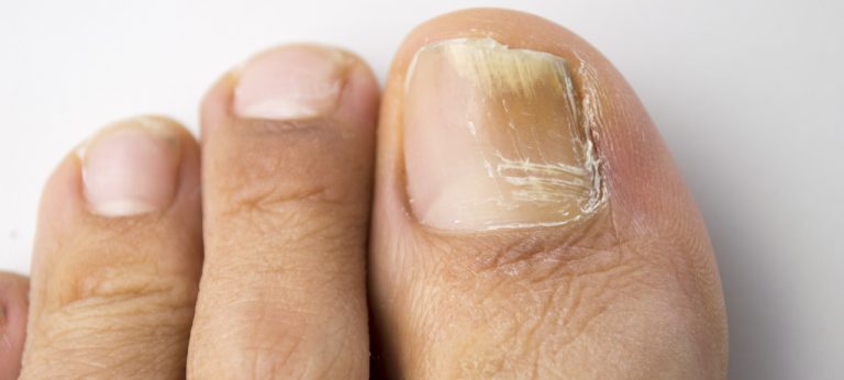 nailfungus