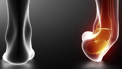 Rehab Exercises to Do After an Ankle Sprain