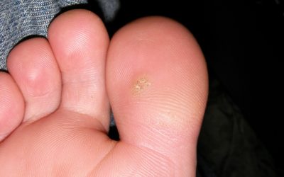 What are Plantar Warts and How Do You Treat Them?