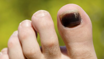 Dark Nails: Fungus or Something Else?