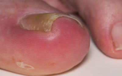 Treating Ingrown Toenails – DIY or Go to a Professional?