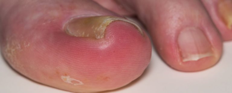ingrowntoenail e1702297561162