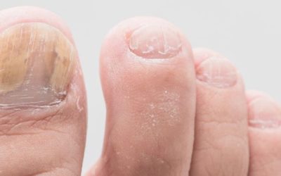 Preventing Ingrown Toenails – Infographic