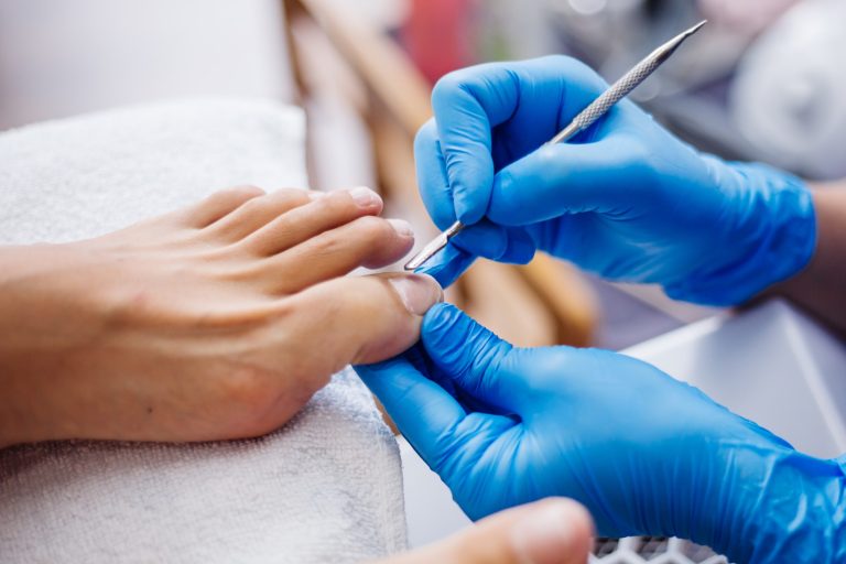 ingrown nail treatment
