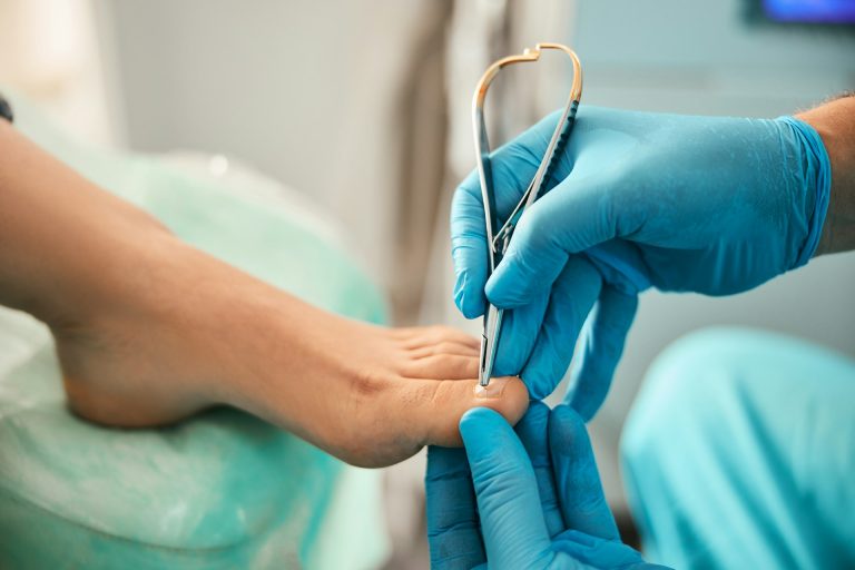 Ingrown Toenail